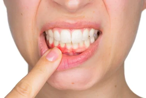 woman indicating gum irritation